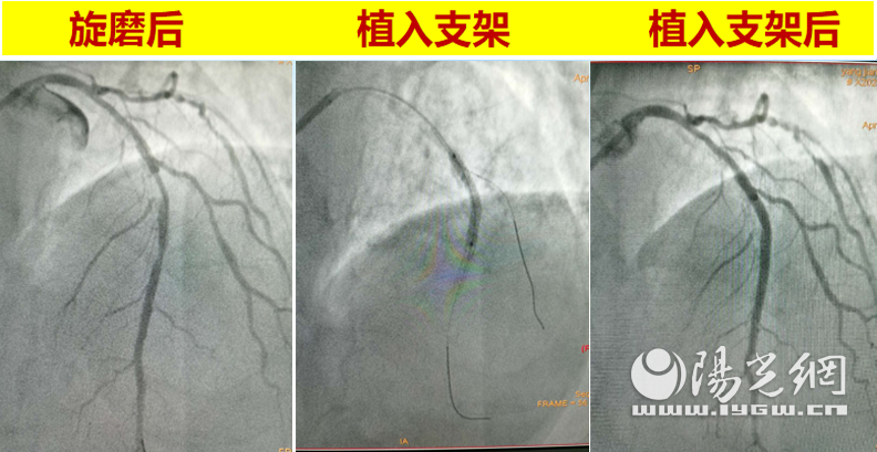 “金刚钻”“劈”开堵塞动脉 西安大兴医院“冠状动脉内膜旋磨术”除病患