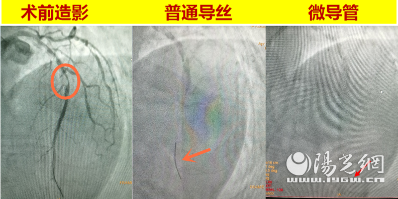 “金刚钻”“劈”开堵塞动脉 西安大兴医院“冠状动脉内膜旋磨术”除病患