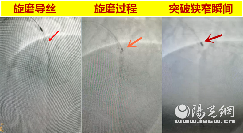 “金刚钻”“劈”开堵塞动脉 西安大兴医院“冠状动脉内膜旋磨术”除病患