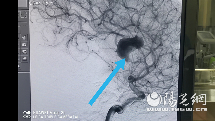 西安市第三医院完成一例高难度颅内巨大夹层动脉瘤手术