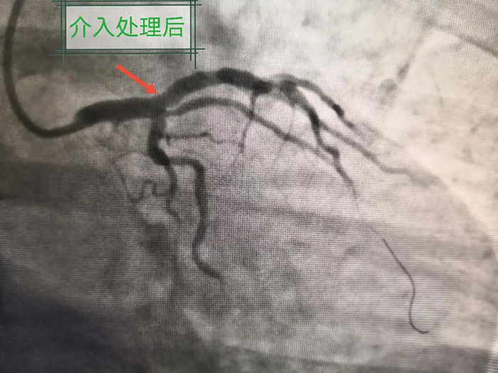 西安市中医医院心血管医生妙手仁心挽救生命