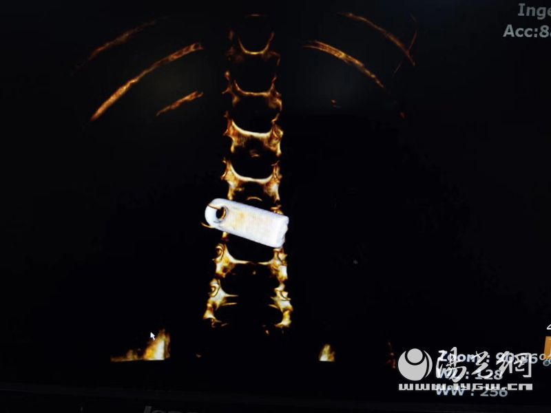 3岁女孩贪玩误吞U盘，西安大兴医院医生妙手除隐患