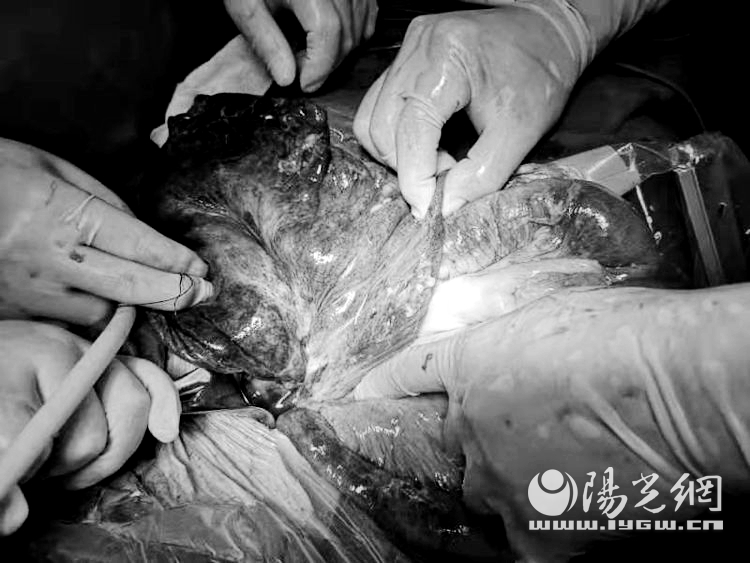 “便秘”原是肠坏死   耄耋老人险丧命
