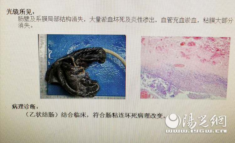 “便秘”原是肠坏死   耄耋老人险丧命