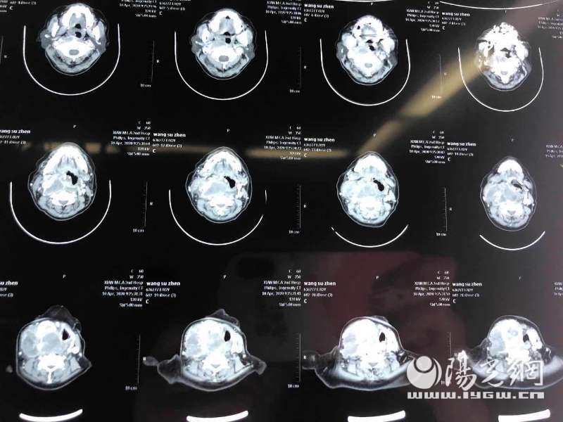 西安大兴医院为患者摘除长了29的甲状腺肿瘤