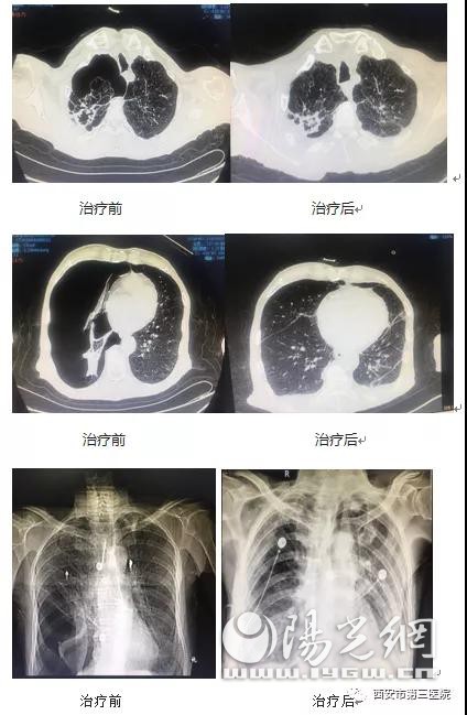西安第三医院成功救治高龄慢阻肺合并大量气胸患者