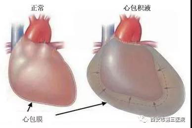 第三医院成功救治一例全血细胞减少合并心包大量积液患者
