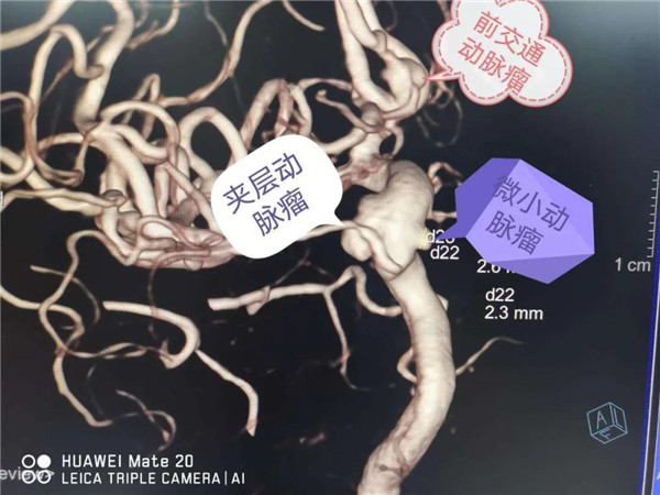 西安市第三医院 一次手术解决3枚脑动脉瘤