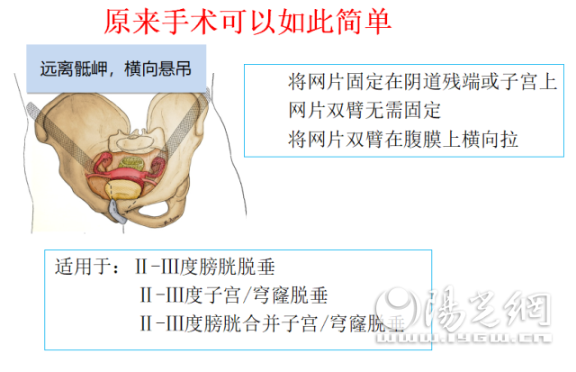 腹膜腔 子宮